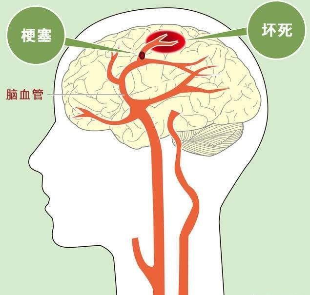 脑梗塞的饮食注意事项有哪些？ 